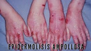 Epidermolisis ampollosa [upl. by Evita]