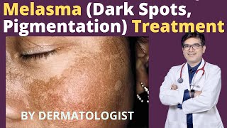 Melasma Treatment  Dark Spots Pigmentation Treatment  Dr Sunil Kothiwala  Dermatologist [upl. by Osterhus]