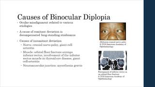 Binocular vs Monocular Diplopia [upl. by Sheya]