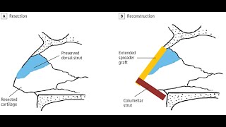 Modified Anterior Nasal Septal Transplant Technique [upl. by Short]