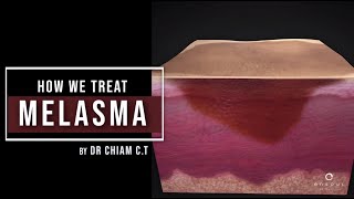 My 4Step Approach to Treating Melasma  Dr Chiam Chiak Teng [upl. by Malo]