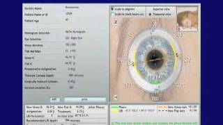 Astigmatism Correction  Cataract Surgery  Part 1 [upl. by Weber16]