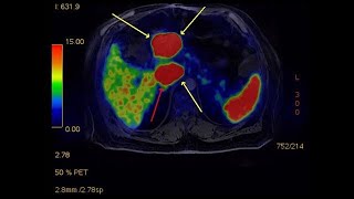 Pancreas Cancer with Liver Metastasis  Treatment with Homeopathy [upl. by Zenda408]