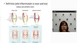 Rheumatoid Arthritis Pathophysiology  Rheumatoid Arthritis Pathogenesis  Arthritis pathophysiology [upl. by Solahcin565]