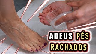 Acabe com as Rachaduras nos Pés e Deixe os Pés Macios com apenas 2 Ingredientes [upl. by Nereus]