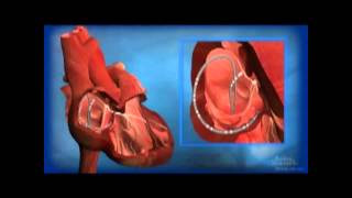 Ablation for AV Node Reentrant Tachycardia AVNRT [upl. by Odnamla345]