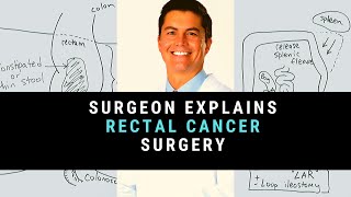 Facing Lung Cancer Surgery—What to Expect [upl. by Deb]