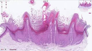 Verruca Vulgaris  Histopathology [upl. by Yelnek696]