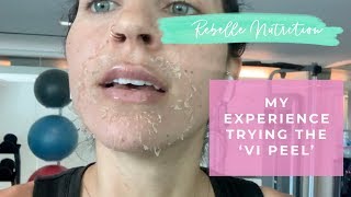 MY EXPERIENCE  Vi Peel For Hyperpigmentation Melasma [upl. by Urian]