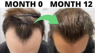 SEVERE Hair Loss To EPIC Hair Growth Subscriber REVERSES Male Pattern Baldness In 1 Year [upl. by Chinua]