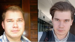 Truth About Finasteride My 12 Year Update Results [upl. by Nomde]