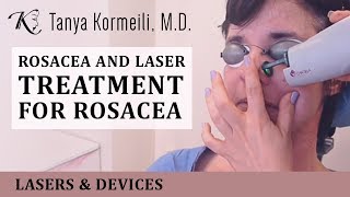 Rosacea and laser treatment for rosacea [upl. by Alvar258]