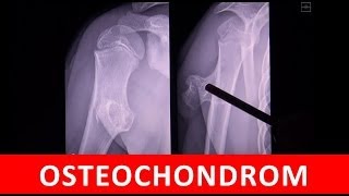 Osteochondrom  MRT CT und Röntgen Darstellung  by Radiologie TV [upl. by Nylanna]