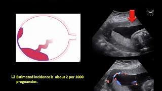 The Placenta and Umbilical Cord Ultrasound Video Lecture [upl. by Alpers970]