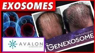 5 Things about Exosomes and Hair Loss [upl. by Leid185]