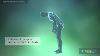 Kyphosis Symptoms [upl. by Pyne749]