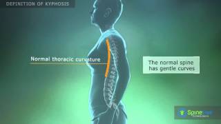 Kyphosis Definition [upl. by Arri]