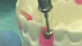 Placing Implant Abutments [upl. by Toomin]