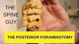 CERVICAL STENOSIS RADICULOPATHY  PART 4  THE POSTERIOR FORAMINOTOMY [upl. by Lennad]