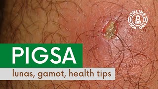 PIGSA Lunas Gamot at Health Tips  Anong Dapat Gawin Kapag May Pigsa o Boil [upl. by Eltsyrk]