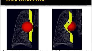 Mediastinal masses approach [upl. by Loram]