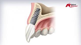 Angulated Screw Channel ASC Abutment [upl. by Airtap]