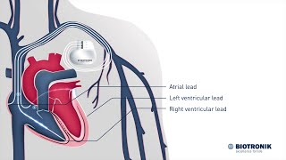 Cardiac Resynchronization Therapy – How it works [upl. by Uoliram]