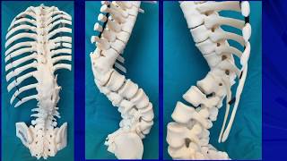 Vertebral column resection for severe kyphosis [upl. by Naget584]