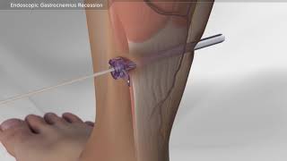 Endoscopic Gastrocnemius Recession [upl. by Julia996]