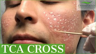 Acne Scar Removal with TCA Cross 80  Los Angeles  Dr Ben Behnam [upl. by Ecyle980]