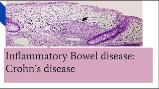 Crohns Disease and Its Effect on the Body [upl. by Aenel54]