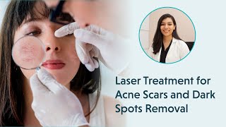 Laser Treatment for Acne Scars  Laser Treatment for Dark Spots Removal [upl. by Nolasba]