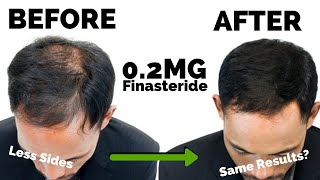 Microdosing Finasteride BREAKTHROUGH 02mg  New Dosage [upl. by Roosnam]