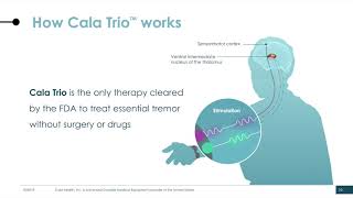 Essential Tremor Treatment  MRGuided Focused Ultrasound  John Wilsons Story [upl. by Ydissac]