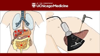 Management of Acute Pancreatitis [upl. by Schoenburg]