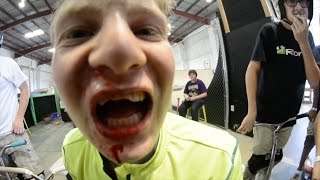 EPIC FACEPLANT  BROKEN TEETH [upl. by Ial]