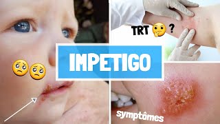 IMPETIGO  CAUSES  SYPMTOMES  COMPLICATIONS  TRAITEMENT [upl. by Hsekin]