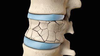 Back Surgery  Vertebroplasty and Kyphoplasty  Nucleus Health [upl. by Judy868]