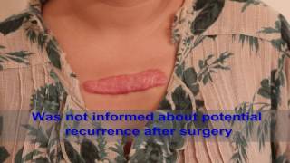 Chest Keloids  Mistakes to Avoid [upl. by Mcconaghy]