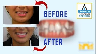 Invisalign Before and After Crowded Teeth [upl. by Gratianna]