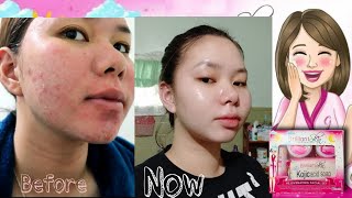 15 Days Using BRILLIANT SKIN ESSENTIAL ✅ REJUVENATING SET REVIEW [upl. by Eixel]