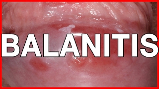 Balanitis Symptoms Causes Treatment and Prevention [upl. by Acsecnarf]