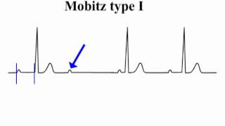 ECG Interpretation  AtrioVentricular Block [upl. by Valdemar]