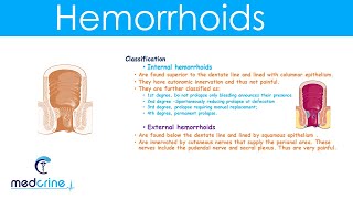 Hemorrhoids  causestypesclinical featuresdiagnosis and treatment [upl. by Ahsytal]