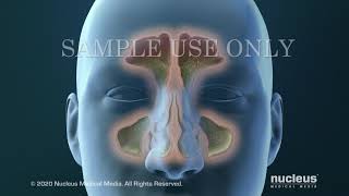 Sinusitis Surgery [upl. by Corinne]