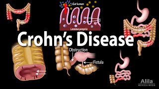 Doenças Inflamatórias Intestinais  Sintomas [upl. by Boland594]