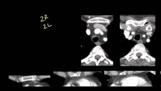 Mediastinal anatomy and nodal stations on CT [upl. by Sondra870]