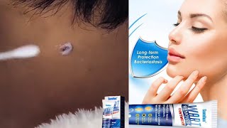 Instant Blemish Removal Gel  Sumifun Wart Remover [upl. by Naired]