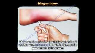 Stingray fish injury  Everything You Need To Know  Dr Nabil Ebraheim [upl. by Siednarb]