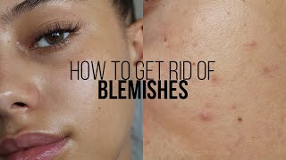 HOW TO GET RID OF BLEMISHES IN 3 DAYS  Jessicvpimentel [upl. by Kowatch]